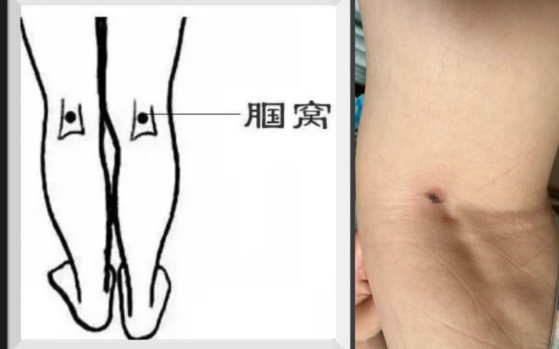 恙蟲病東方體。